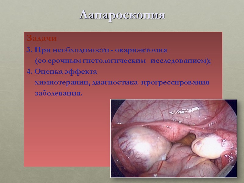 Лапароскопия Задачи 3. При необходимости - овариэктомия      (со срочным